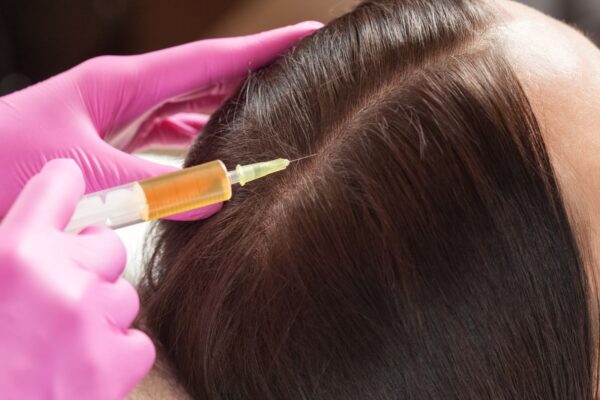 Le traitement PRP contre la perte de cheveux est-il pour moi ?
