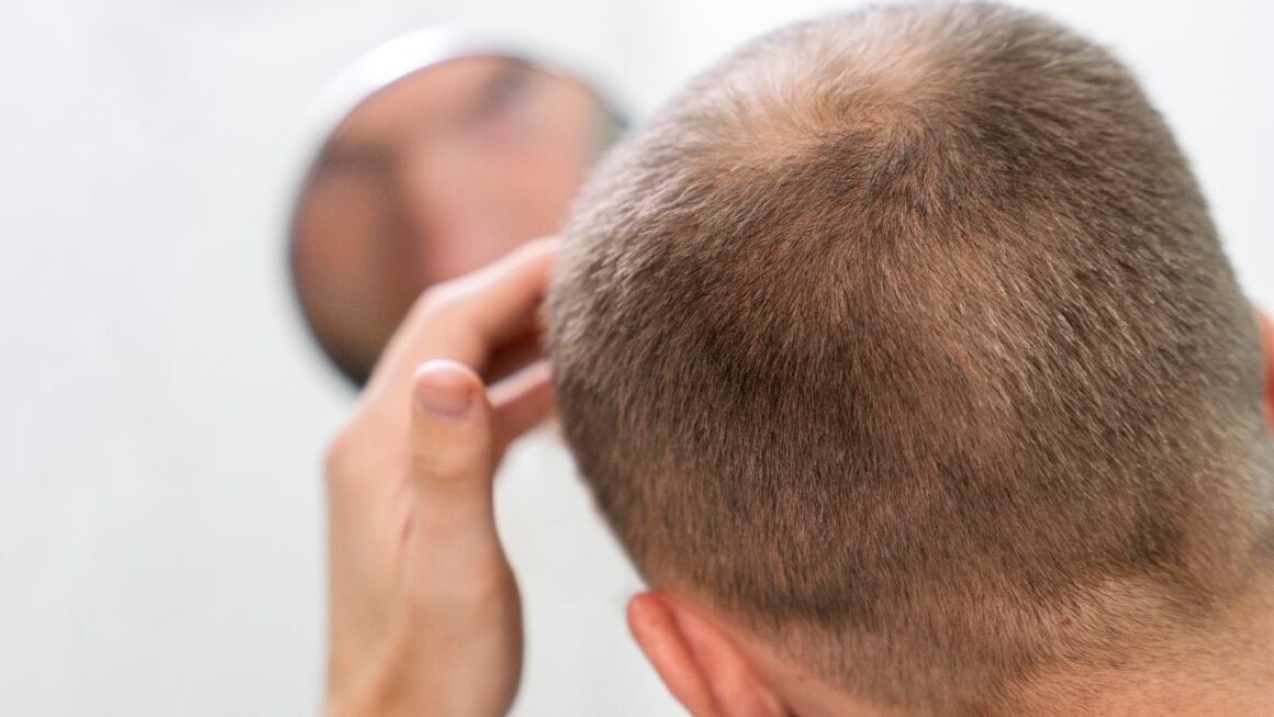 La Greffe de Cheveux Saphir : Une Révolution Esthétique pour Contrer la Perte Capillaire